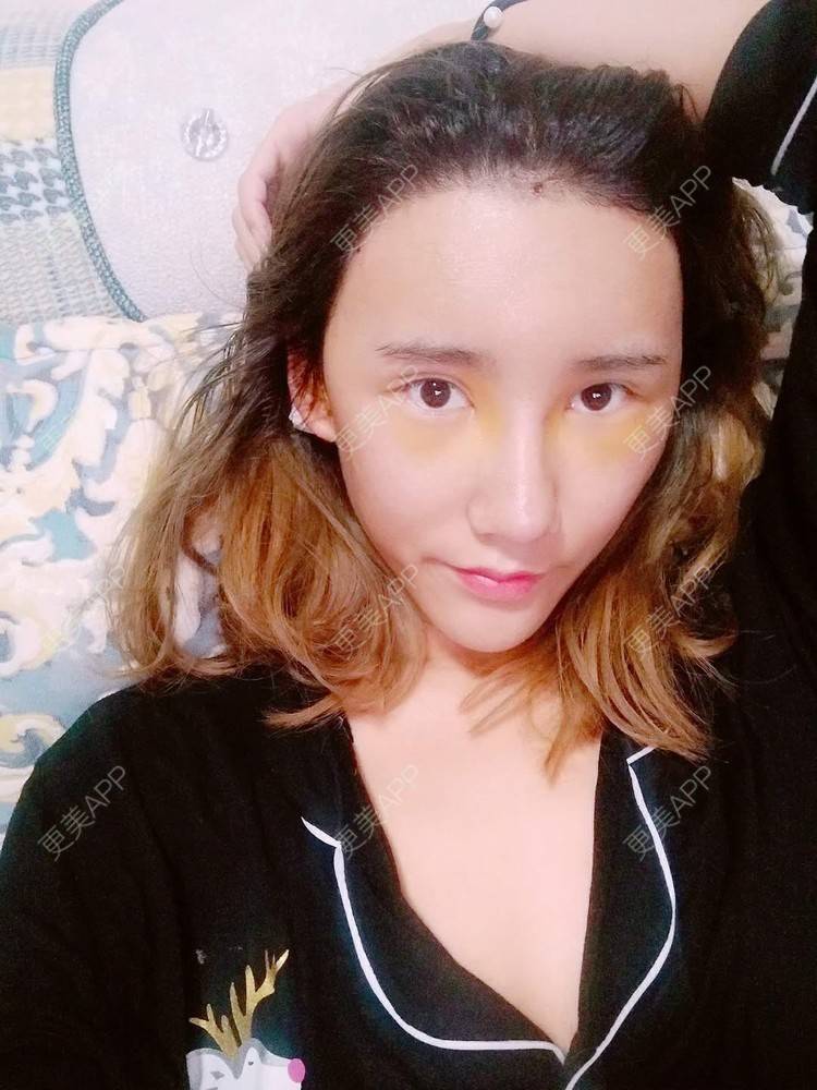 更美 - 更美用户CgtfiDRXHz的自体脂肪丰苹果肌经验 | 自体脂肪全面部填充 | 自体脂肪丰面颊 | 自体脂肪丰太阳穴 | 哈尔滨
