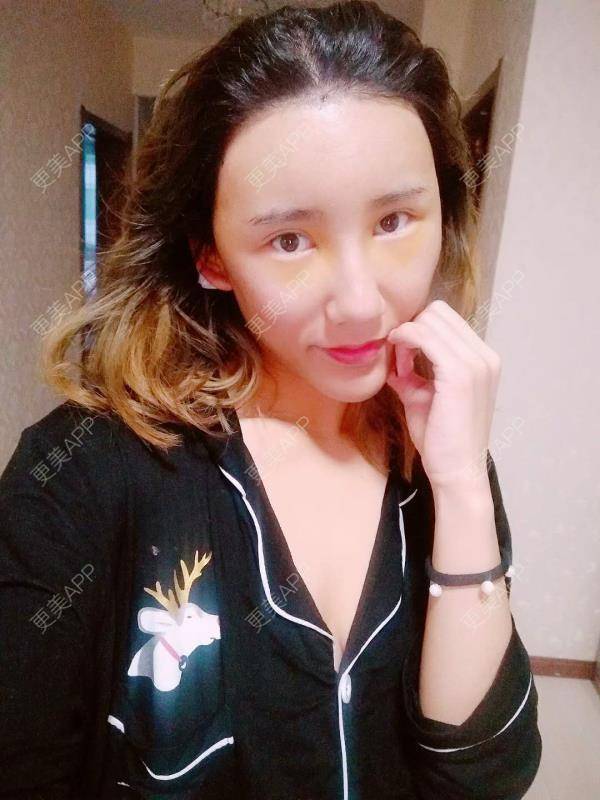 更美 - 更美用户CgtfiDRXHz的自体脂肪丰苹果肌经验 | 自体脂肪全面部填充 | 自体脂肪丰面颊 | 自体脂肪丰太阳穴 | 哈尔滨