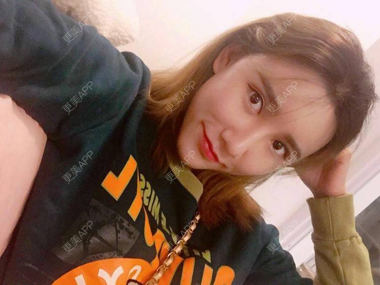 更美 - 更美用户CgtfiDRXHz的自体脂肪丰苹果肌经验 | 自体脂肪全面部填充 | 自体脂肪丰太阳穴 | 自体脂肪丰苹果肌 | 自体脂肪丰面颊 | 哈尔滨
