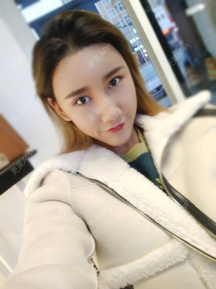更美 - 更美用户CgtfiDRXHz的自体脂肪丰苹果肌经验 | 自体脂肪全面部填充 | 自体脂肪丰太阳穴 | 自体脂肪丰苹果肌 | 自体脂肪丰面颊 | 哈尔滨