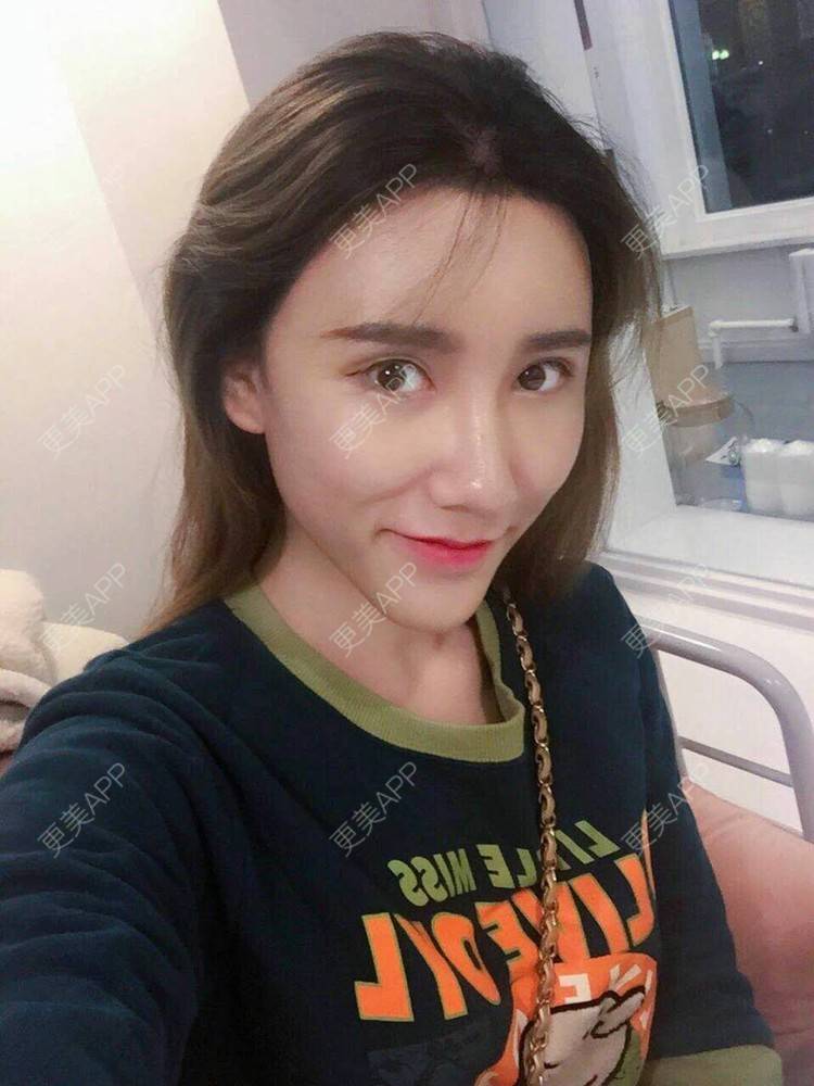 更美 - 更美用户CgtfiDRXHz的自体脂肪丰苹果肌经验 | 自体脂肪全面部填充 | 自体脂肪丰太阳穴 | 自体脂肪丰苹果肌 | 自体脂肪丰面颊 | 哈尔滨