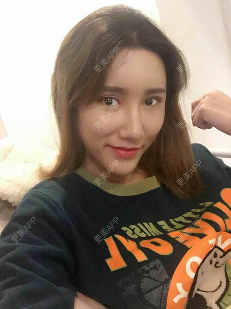 更美 - 更美用户CgtfiDRXHz的自体脂肪丰苹果肌经验 | 自体脂肪全面部填充 | 自体脂肪丰太阳穴 | 自体脂肪丰苹果肌 | 自体脂肪丰面颊 | 哈尔滨