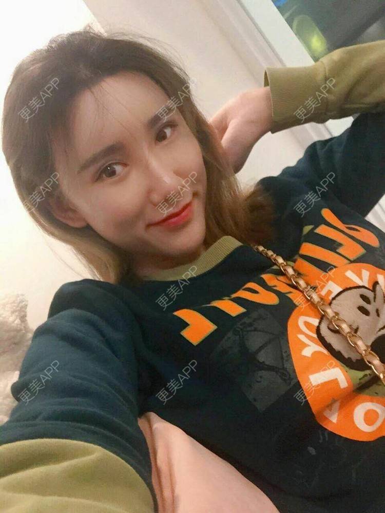 更美 - 更美用户CgtfiDRXHz的自体脂肪丰苹果肌经验 | 自体脂肪全面部填充 | 自体脂肪丰太阳穴 | 自体脂肪丰苹果肌 | 自体脂肪丰面颊 | 哈尔滨