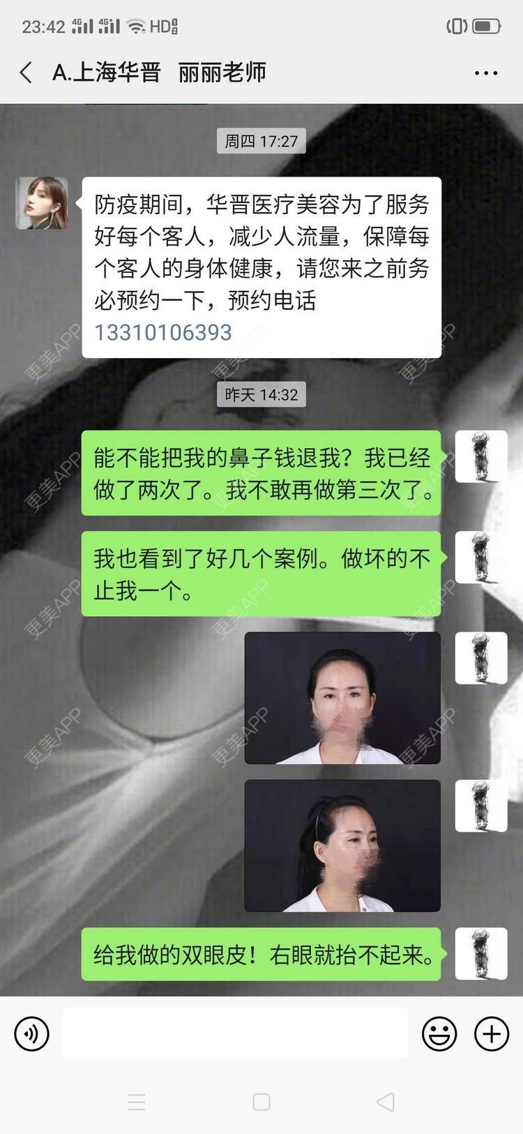更美 - 本人的失败经历的硅胶隆鼻经验 | 硅胶隆鼻 | 上海