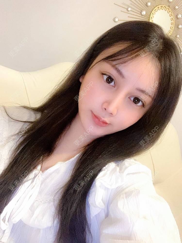 更美 - 甜甜甜儿的鼻部多项经验 | 肋软骨隆鼻 | 膨体隆鼻 | 玻尿酸鼻部 | 自体脂肪隆鼻 | 硅胶隆鼻 | 鼻部多项 | 手术缩鼻头 | 自体软骨垫鼻尖 | 重庆 | 鼻中隔软骨垫鼻头 | 玻尿酸 | 耳软骨隆鼻