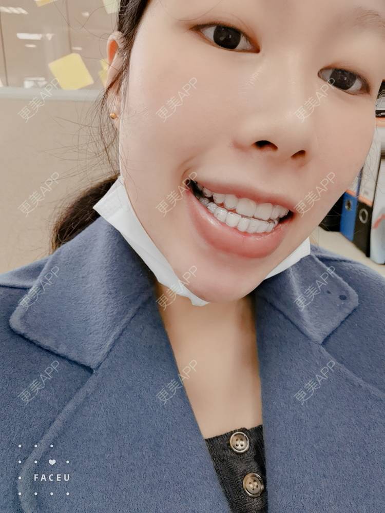 更美 - 西瓜西瓜圓又大🍉的隐形牙齿矫正经验 | 隐形牙齿矫正 | 上海