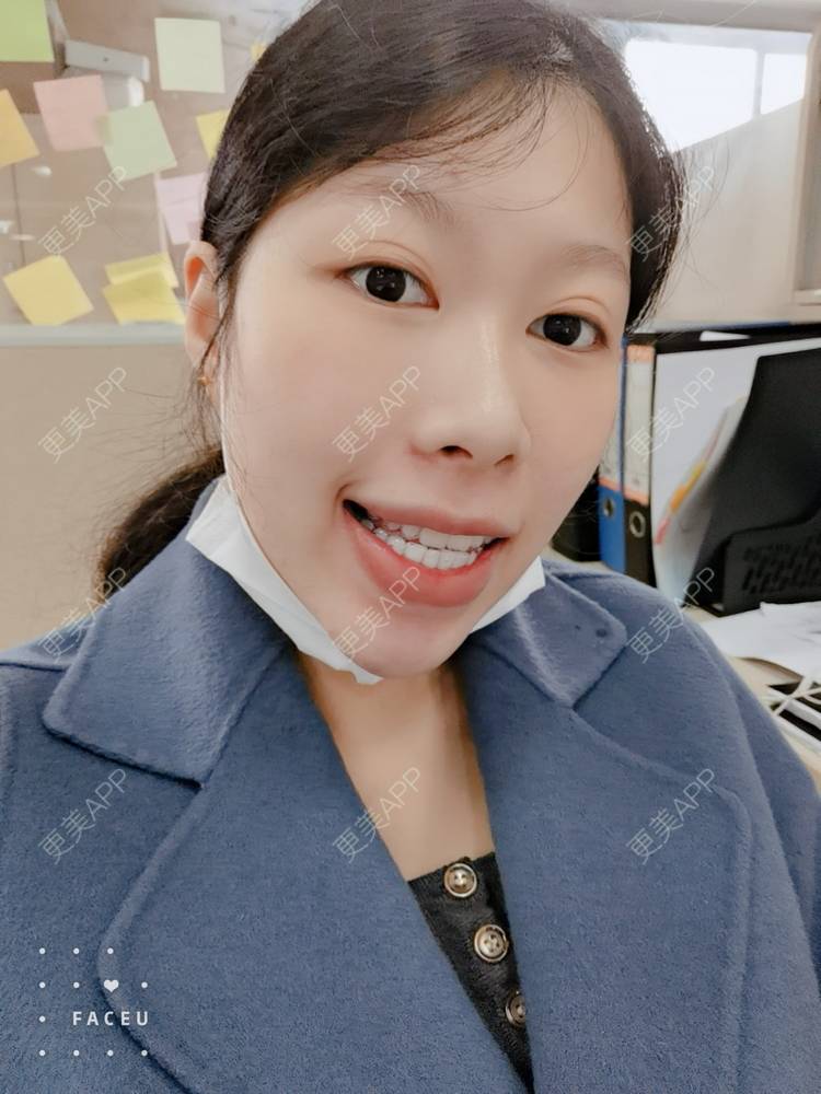 更美 - 西瓜西瓜圓又大🍉的隐形牙齿矫正经验 | 隐形牙齿矫正 | 上海