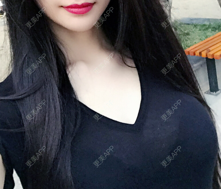 更美 - 更美用户wBYsgLTQ9p的假体隆胸经验 | 假体隆胸 | 广州