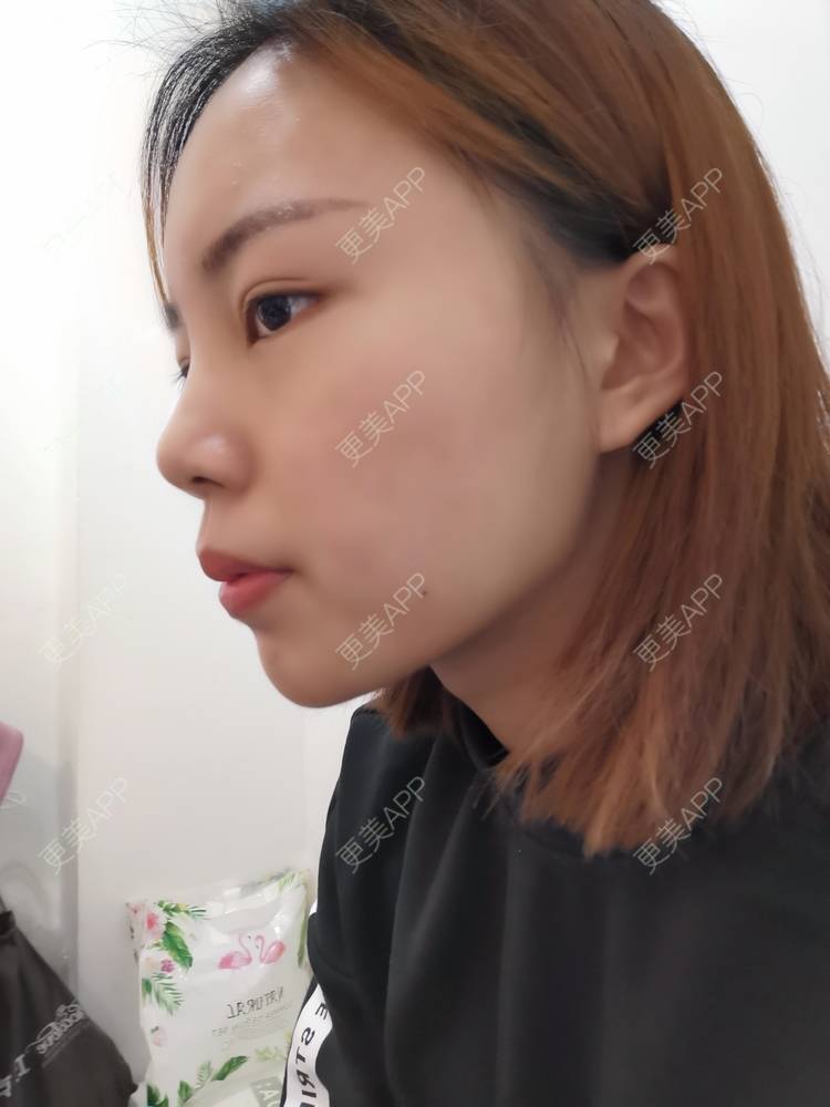 太空船的玻尿酸下巴日记