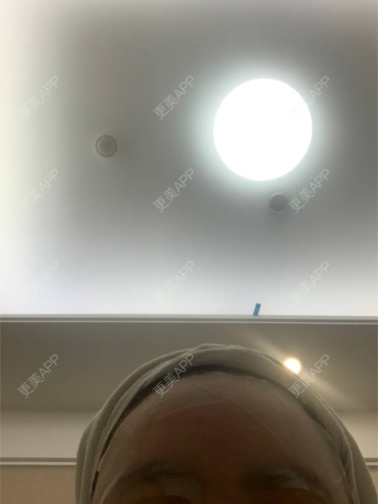 更美 - 更美用户YX8CEItWV4的微针水光经验 | 重庆 | 微针水光