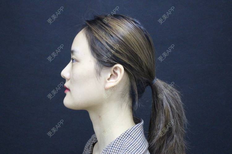 更美 - 更美用户g2U36BucF7的自体脂肪丰卧蚕经验 | 自体脂肪丰卧蚕 | 自体脂肪丰太阳穴 | 自体脂肪丰额头 | 赣州
