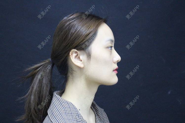 更美 - 更美用户g2U36BucF7的自体脂肪丰卧蚕经验 | 自体脂肪丰卧蚕 | 自体脂肪丰太阳穴 | 自体脂肪丰额头 | 赣州