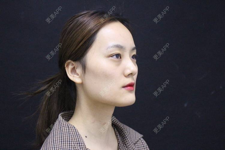 更美 - 更美用户g2U36BucF7的自体脂肪丰卧蚕经验 | 自体脂肪丰卧蚕 | 自体脂肪丰太阳穴 | 自体脂肪丰额头 | 赣州