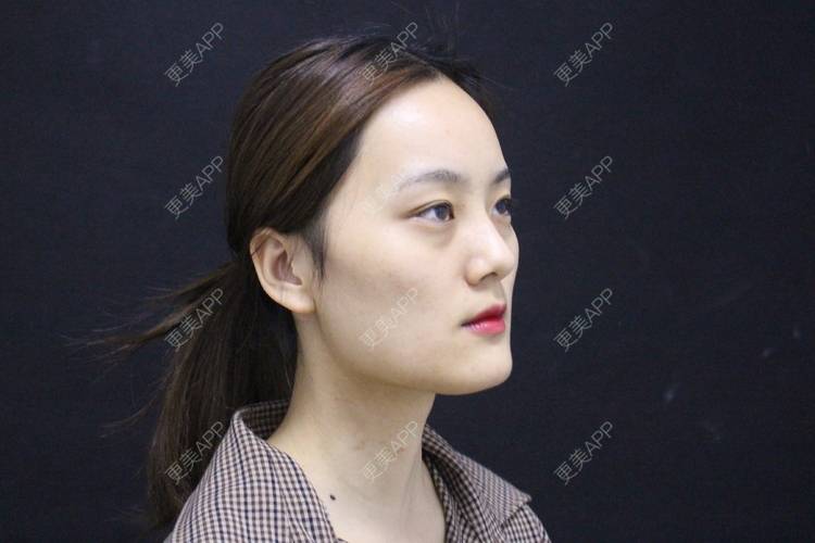 更美 - 更美用户g2U36BucF7的自体脂肪丰卧蚕经验 | 自体脂肪丰卧蚕 | 自体脂肪丰太阳穴 | 自体脂肪丰额头 | 赣州