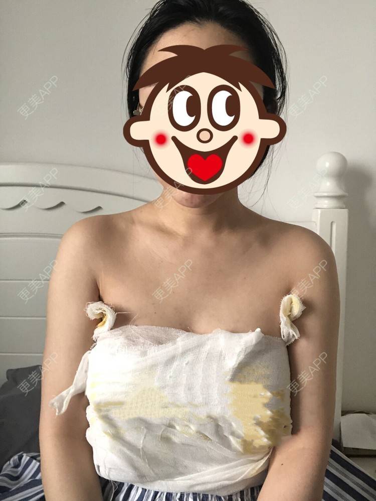 假体隆胸效果图_更美用户qy3zcqr7zc假体隆胸效果图_术后231天__更美