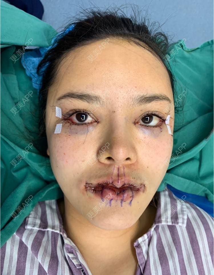 更美用户nj9djdlyg1的m唇成形术日记