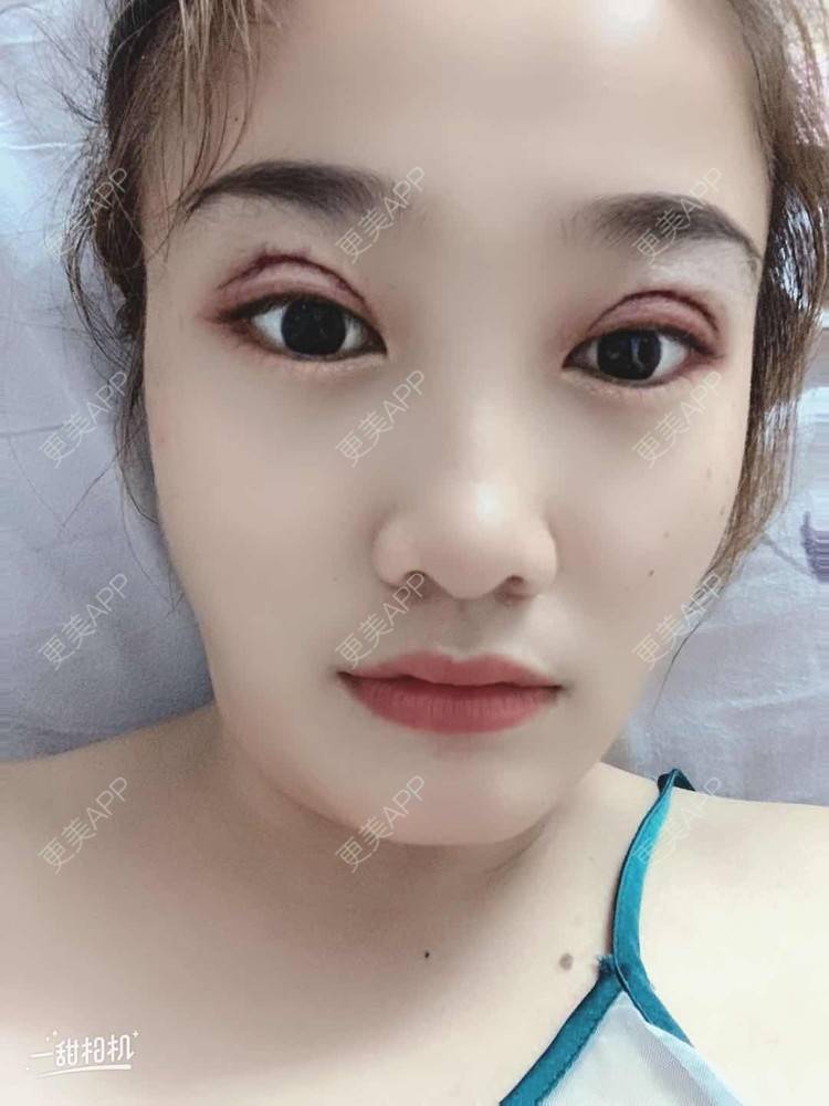 更美 - 蠻獲潑哋あ駭籽济的全切双眼皮经验 | 全切双眼皮 | 眼部多项 | 上眼睑去脂 | 北京