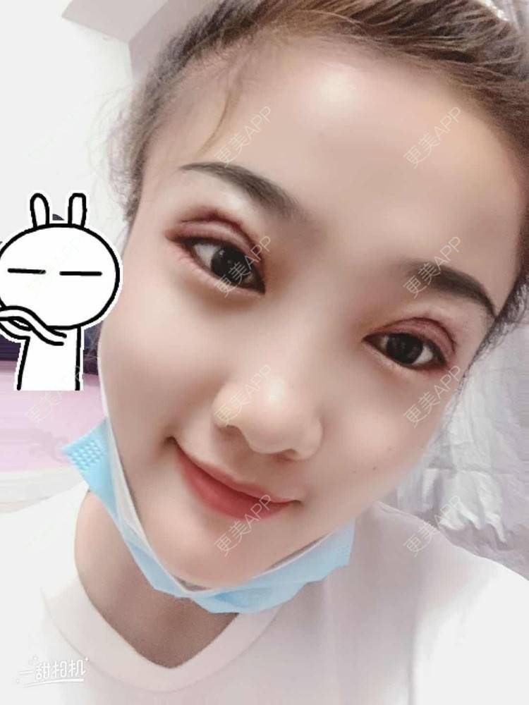 更美 - 蠻獲潑哋あ駭籽济的全切双眼皮经验 | 全切双眼皮 | 眼部多项 | 上眼睑去脂 | 北京