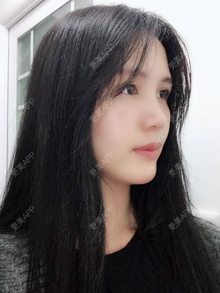 更美 - Missking的下巴截骨前移经验 | 硅胶垫下巴 | 自体脂肪丰面颊 | 下巴截骨前移 | 膨体垫下巴 | 深圳