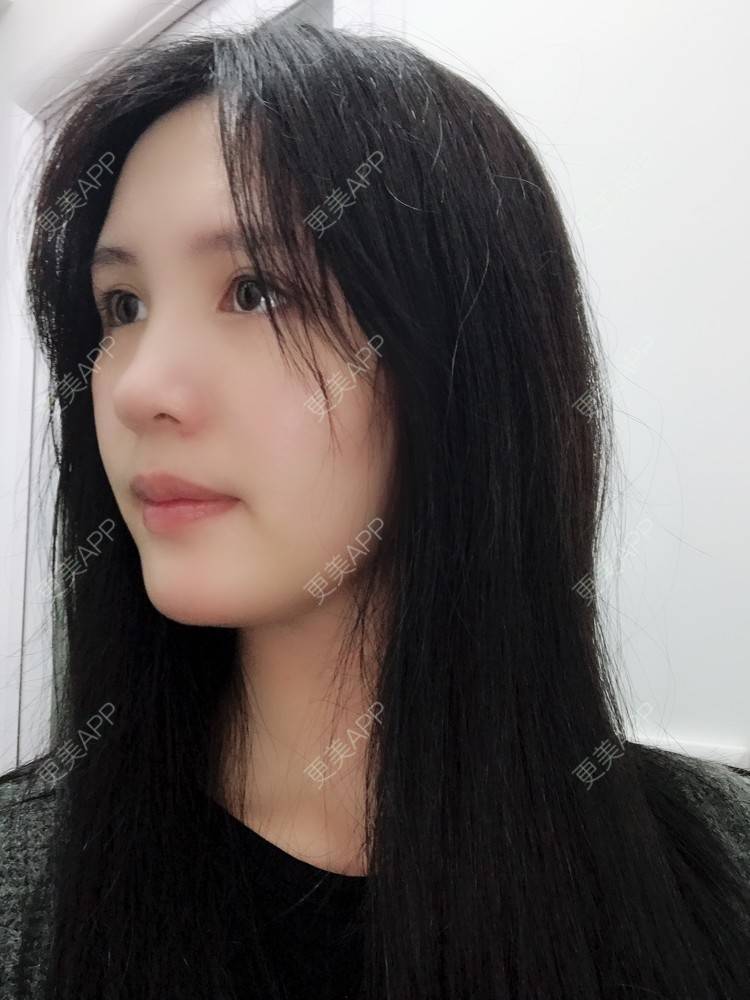 更美 - Missking的下巴截骨前移经验 | 硅胶垫下巴 | 自体脂肪丰面颊 | 下巴截骨前移 | 膨体垫下巴 | 深圳