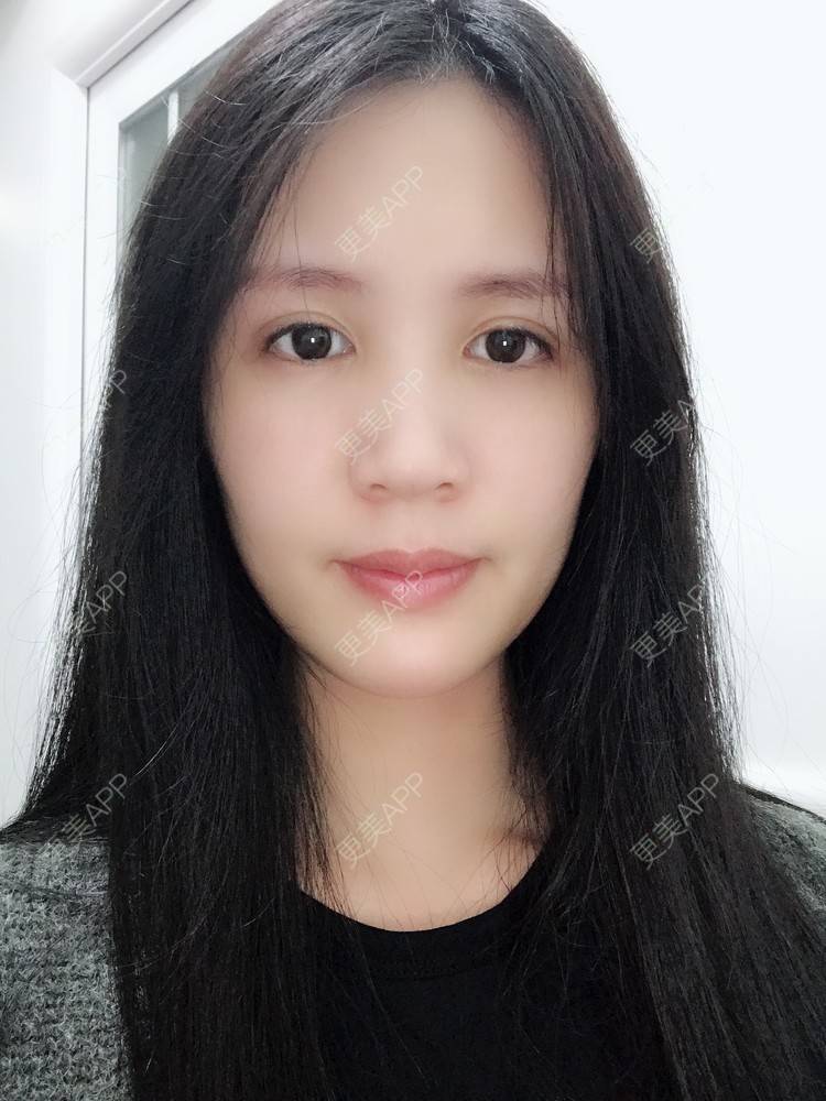 更美 - Missking的下巴截骨前移经验 | 硅胶垫下巴 | 自体脂肪丰面颊 | 下巴截骨前移 | 膨体垫下巴 | 深圳
