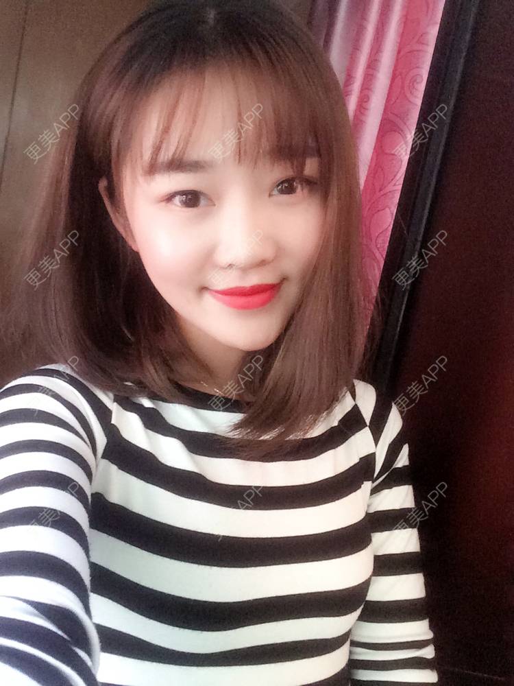 更美 - 更美用户4bRKTqR2Jo的埋线提升经验 | 埋线提升 | 无锡