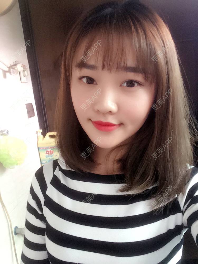 更美 - 更美用户4bRKTqR2Jo的埋线提升经验 | 埋线提升 | 无锡