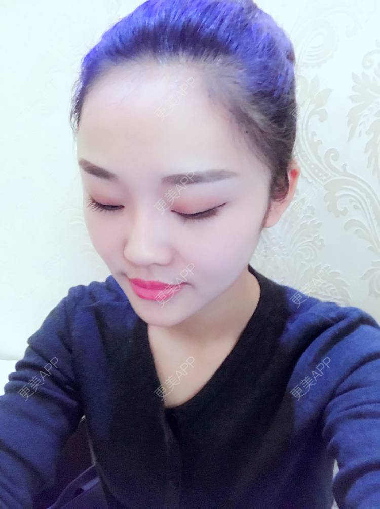 更美 - 更美用户4bRKTqR2Jo的埋线提升经验 | 埋线提升 | 无锡