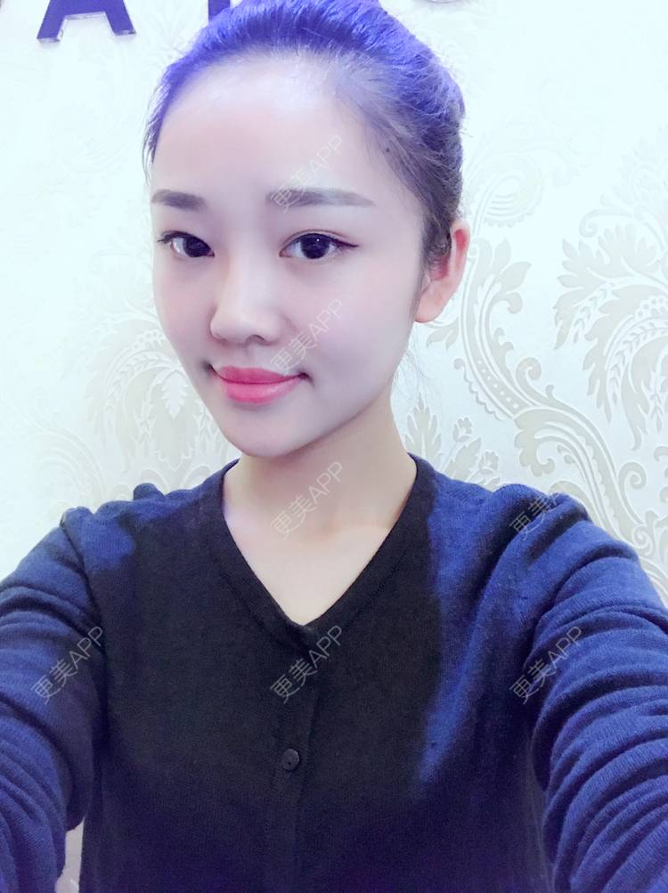 更美 - 更美用户4bRKTqR2Jo的埋线提升经验 | 埋线提升 | 无锡
