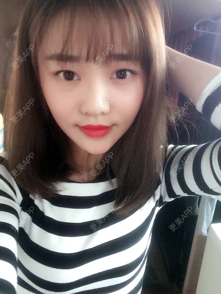 更美 - 更美用户4bRKTqR2Jo的埋线提升经验 | 埋线提升 | 无锡
