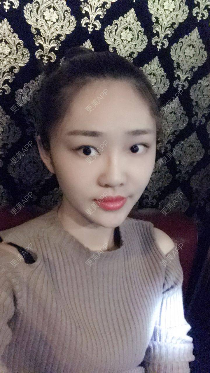 更美 - 更美用户4bRKTqR2Jo的埋线提升经验 | 埋线提升 | 无锡