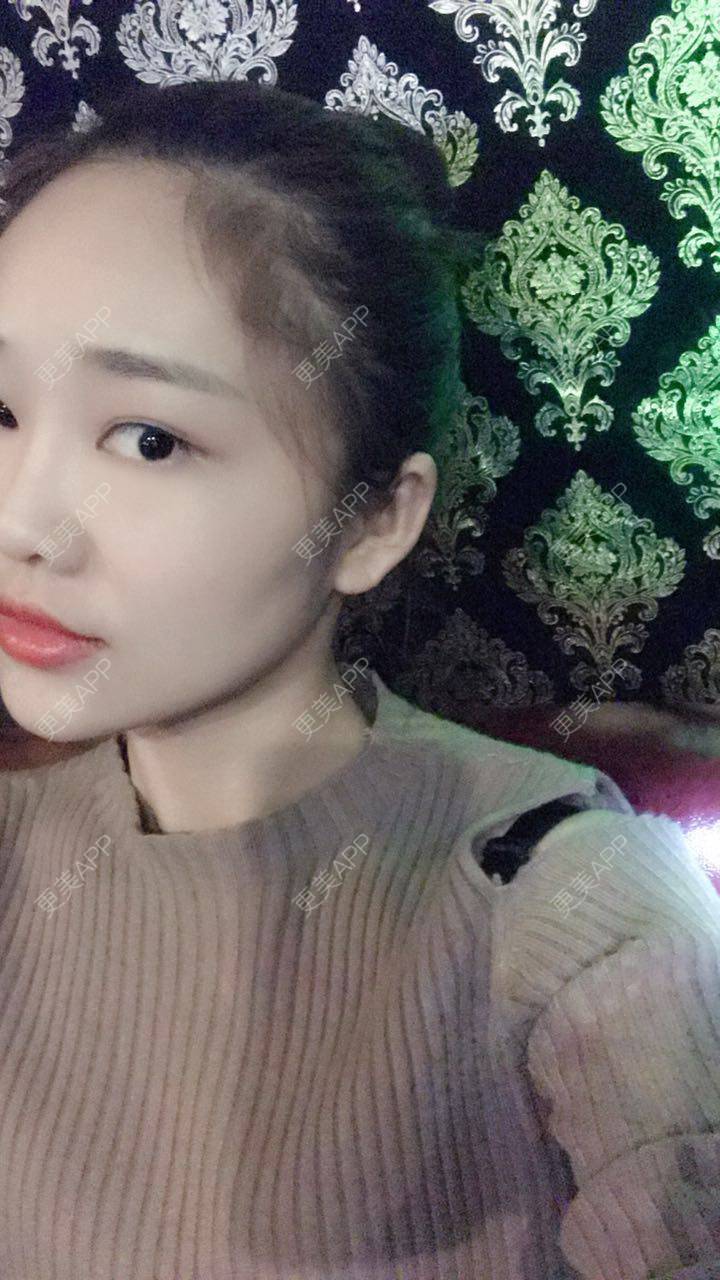 更美 - 更美用户4bRKTqR2Jo的埋线提升经验 | 埋线提升 | 无锡