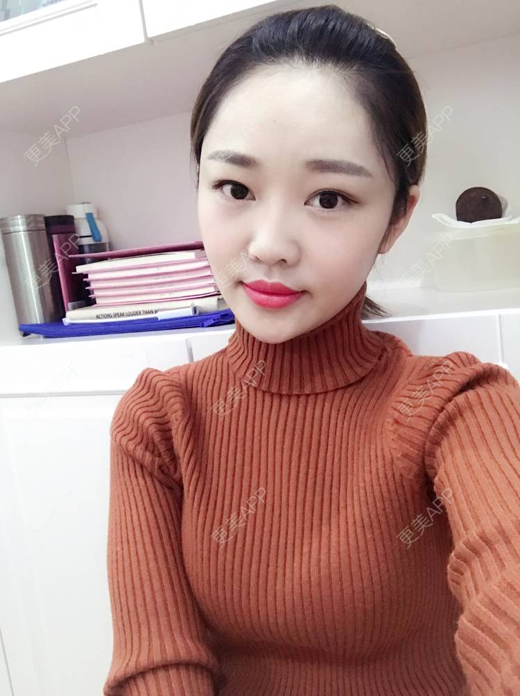 更美 - 更美用户4bRKTqR2Jo的埋线提升经验 | 埋线提升 | 无锡