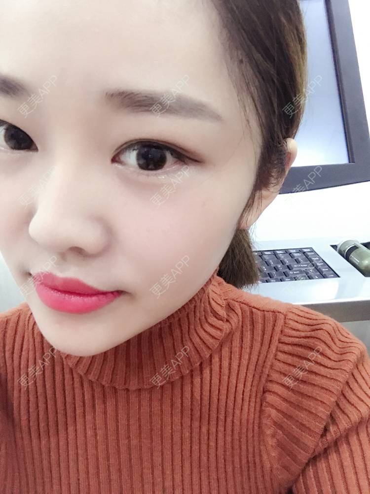 更美 - 更美用户4bRKTqR2Jo的埋线提升经验 | 埋线提升 | 无锡