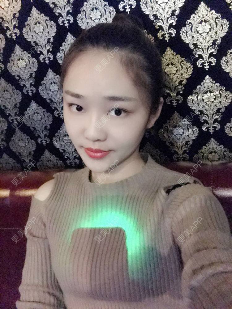 更美 - 更美用户4bRKTqR2Jo的埋线提升经验 | 埋线提升 | 无锡