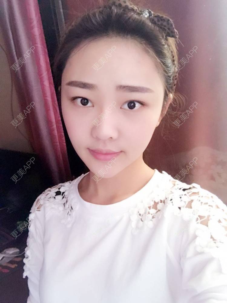 更美 - 更美用户4bRKTqR2Jo的埋线提升经验 | 埋线提升 | 无锡