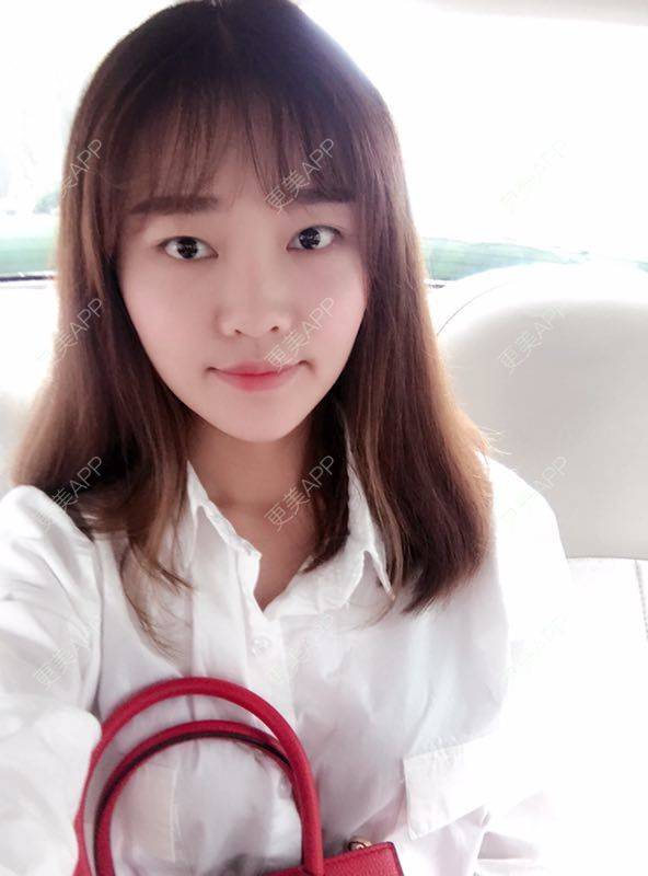 更美 - 更美用户4bRKTqR2Jo的埋线提升经验 | 埋线提升 | 无锡