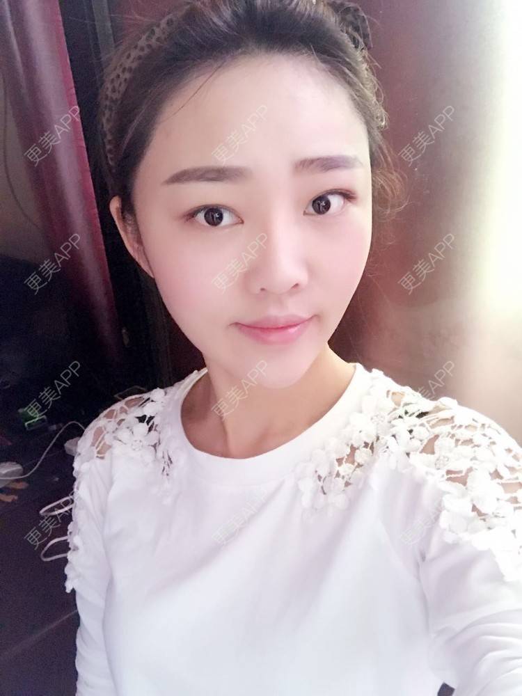 更美 - 更美用户4bRKTqR2Jo的埋线提升经验 | 埋线提升 | 无锡
