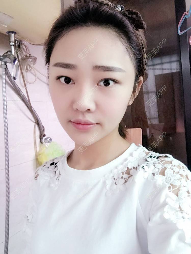 更美 - 更美用户4bRKTqR2Jo的埋线提升经验 | 埋线提升 | 无锡