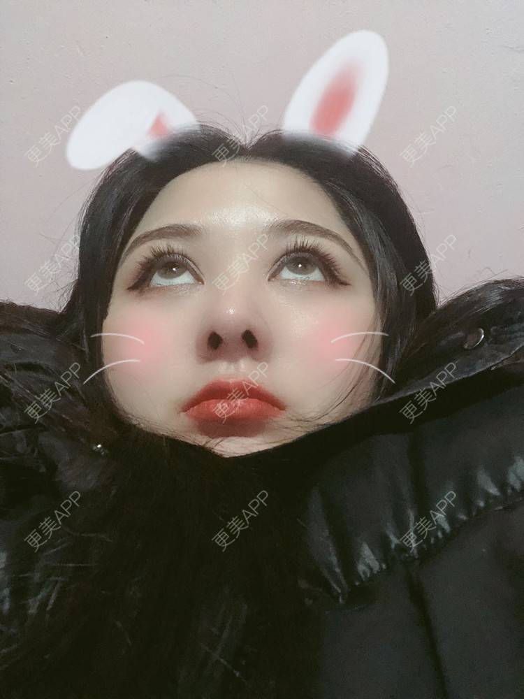 更美 - 无需解释收的鼻部多项经验 | 鼻小柱延长 | 视频日记 | 重庆 | 肋软骨隆鼻 | 鼻部多项