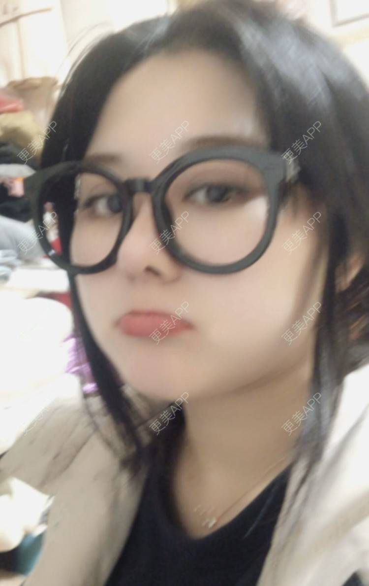 更美 - 无需解释收的鼻部多项经验 | 鼻小柱延长 | 视频日记 | 重庆 | 肋软骨隆鼻 | 鼻部多项