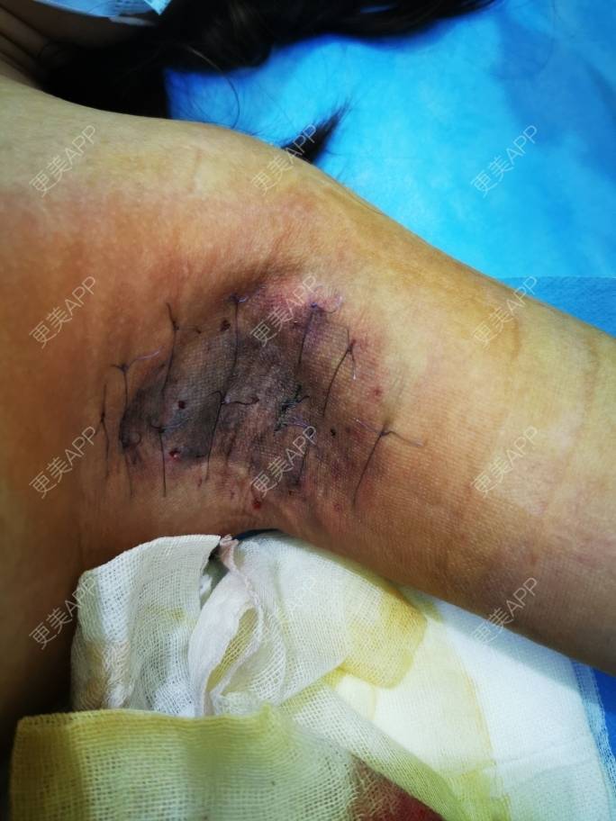 更美用户j9yvhxeoyg的手术除腋臭日记