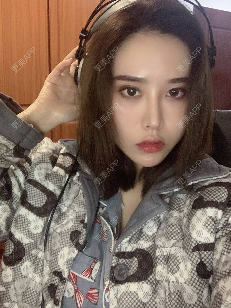 更美 - 未来食神的全切双眼皮经验 | 全切双眼皮 | 开内眼角 | 眼皮下垂矫正 | 重庆 | 双眼皮修复 | 眼部多项 | 开眼角修复