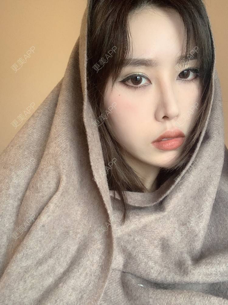 更美 - 未来食神的全切双眼皮经验 | 全切双眼皮 | 开内眼角 | 眼皮下垂矫正 | 重庆 | 双眼皮修复 | 眼部多项 | 开眼角修复