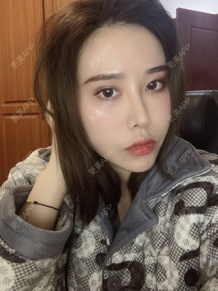 更美 - 未来食神的全切双眼皮经验 | 全切双眼皮 | 开内眼角 | 眼皮下垂矫正 | 重庆 | 双眼皮修复 | 眼部多项 | 开眼角修复