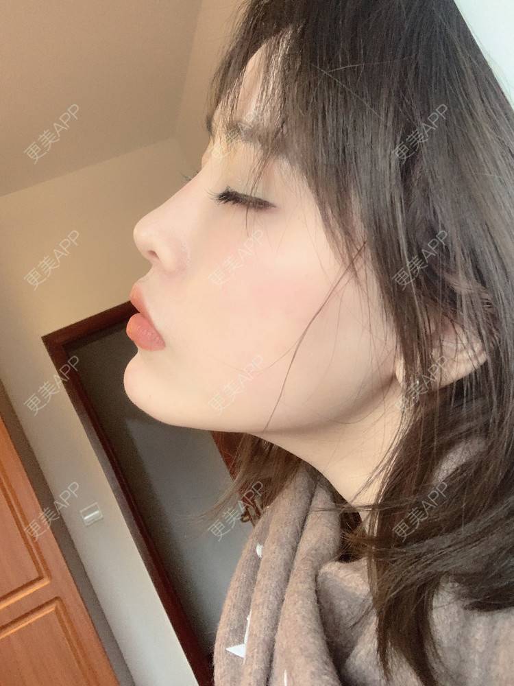 更美 - 未来食神的全切双眼皮经验 | 全切双眼皮 | 开内眼角 | 眼皮下垂矫正 | 重庆 | 双眼皮修复 | 眼部多项 | 开眼角修复