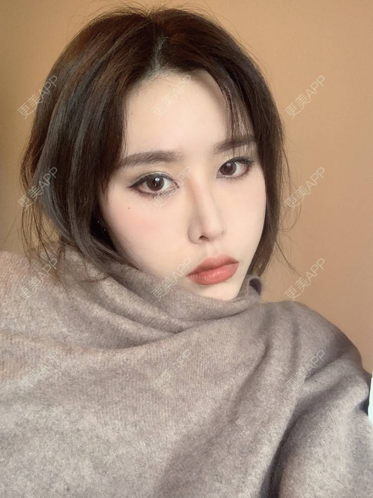 更美 - 未来食神的全切双眼皮经验 | 全切双眼皮 | 开内眼角 | 眼皮下垂矫正 | 重庆 | 双眼皮修复 | 眼部多项 | 开眼角修复