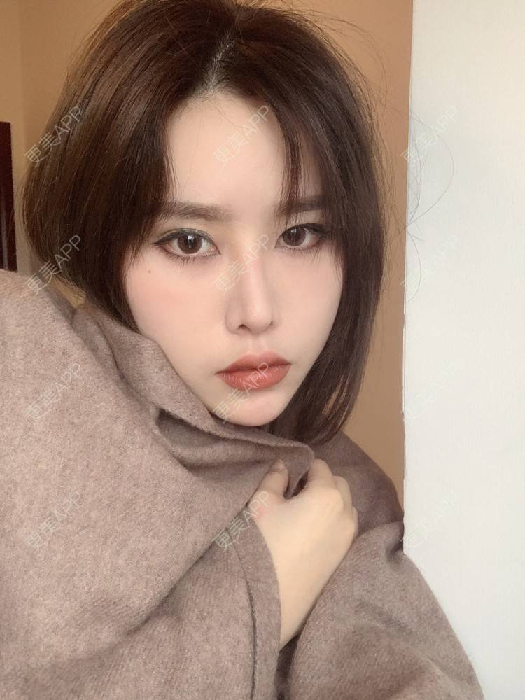 更美 - 未来食神的全切双眼皮经验 | 全切双眼皮 | 开内眼角 | 眼皮下垂矫正 | 重庆 | 双眼皮修复 | 眼部多项 | 开眼角修复