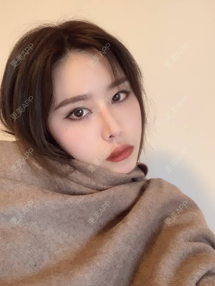 更美 - 未来食神的全切双眼皮经验 | 全切双眼皮 | 开内眼角 | 眼皮下垂矫正 | 重庆 | 双眼皮修复 | 眼部多项 | 开眼角修复