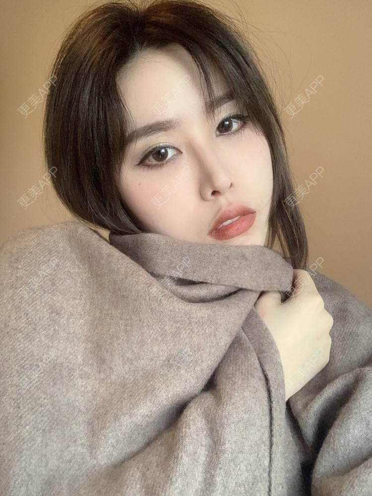 更美 - 未来食神的全切双眼皮经验 | 全切双眼皮 | 开内眼角 | 眼皮下垂矫正 | 重庆 | 双眼皮修复 | 眼部多项 | 开眼角修复